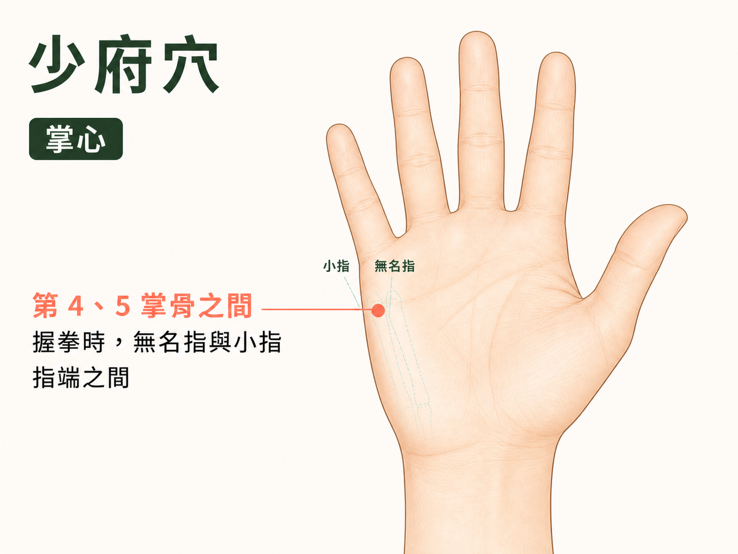 少府穴位置示意圖：掌心第四、五掌骨之間